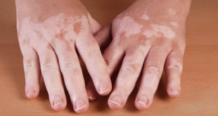 vitiligo