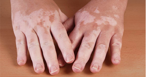 vitiligo