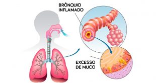 bronquiolite