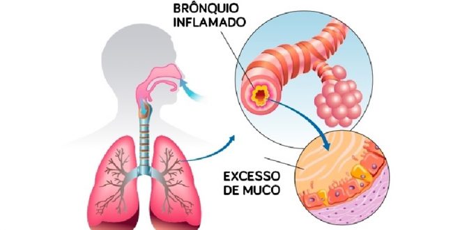 bronquiolite