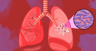 tuberculose