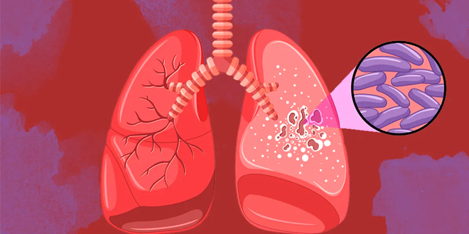 tuberculose